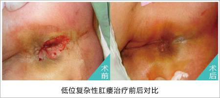 肛瘘手术