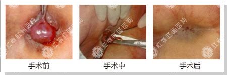 嵌顿性内痔病例