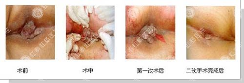 环状混合痔病例