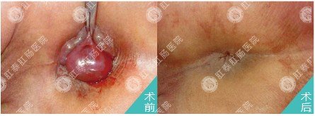 痔疮-典型病例
