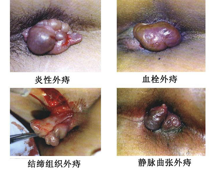 外痔各类痔的实例图