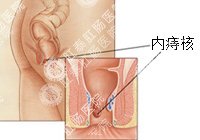 内痔的症状