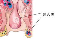 混合痔的症状