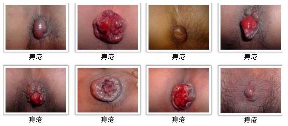 痔疮