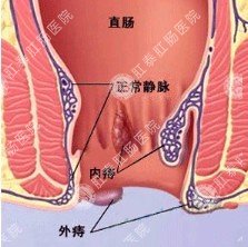 痔疮