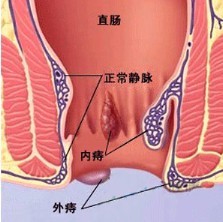 痔疮