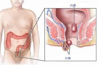 内痔