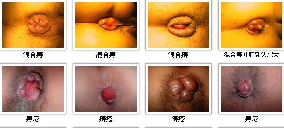 痔疮