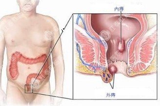 痔疮