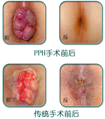 混合痔