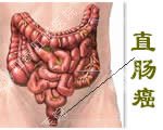 直肠癌