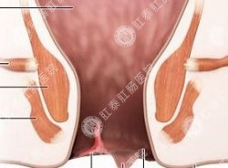 肛裂