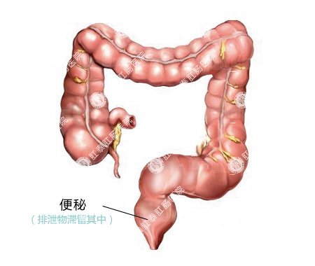 大便困难