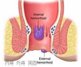 混合痔的症状