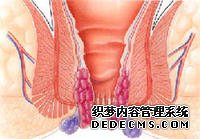 痔疮费用是多少