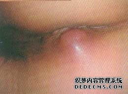 肛周脓肿的危害