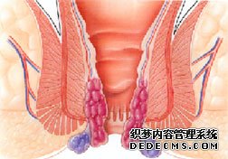 混合痔有哪些危害