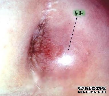 肛裂该如何预防