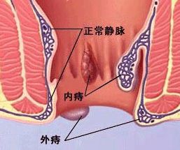 混合痔