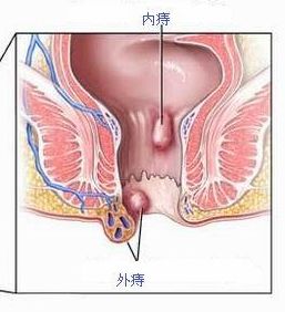引起混合痔的原因有哪些