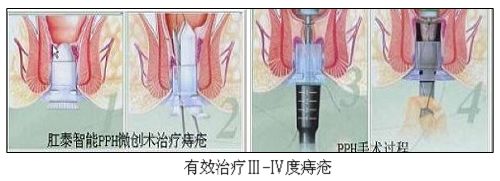 治疗痔疮的土方法有哪些?